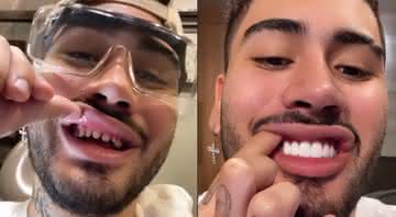 Kevinho trocou as lentes dos dentes - Instagram
