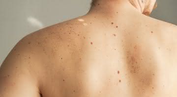 Dezembro Laranja: médica explica como prevenir o câncer de pele - Freepik