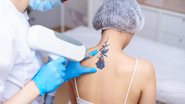 Procedimento estético pode remover completamente as tatuagens (Imagem: ViktoriiaNovokhatska | Shutterstock)