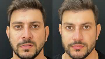 Caio Afiune faz harmonização facial; Veja fotos do antes e depois - Instagram