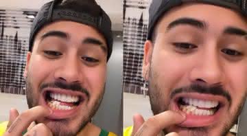 Kevinho quebra lentes provisórias dos dentes - Reprodução/ Instagram
