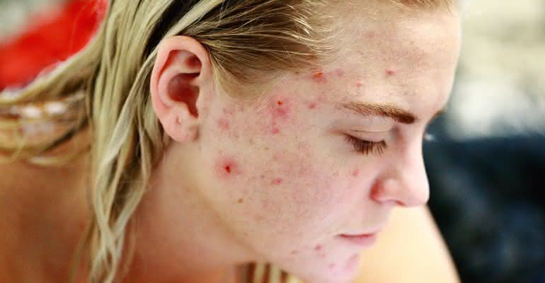 Roseli Siqueira revela como minimizar as acnes do rosto - Freepik