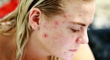 Roseli Siqueira revela como minimizar as acnes do rosto - Freepik