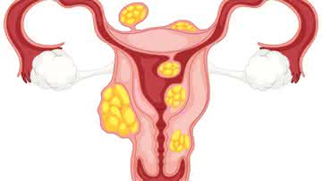 Miomas uterinos: Especialista tira principais dúvidas sobre a condição - Freepik